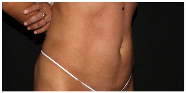 before_after_neo_abdomen_fem2_a