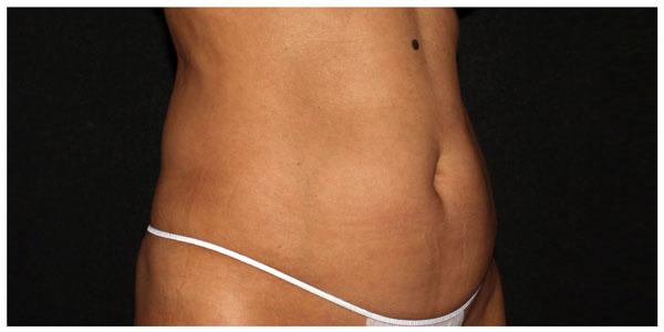 before_after_neo_abdomen_fem2_b