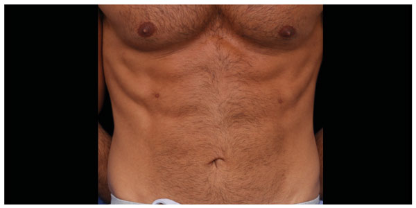 before_after_neo_abdomen_man_a