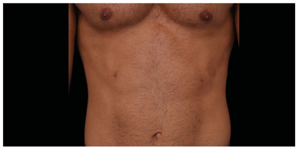 before_after_neo_abdomen_man_b