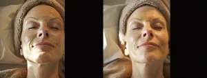 a woman with glowing, rejuvenated skin, smiling as she relaxes during a chemical peel treatment at lemel med spa.